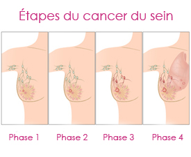 L’évolution du cancer du sein
